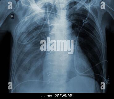 Examen radiographique du patient après une chirurgie cardiaque. Banque D'Images