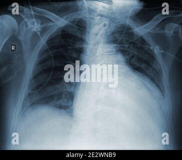 Radiographie du patient atteint d'une maladie cardiaque après une intervention chirurgicale. Banque D'Images