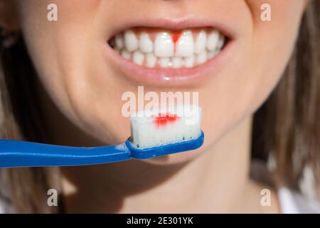 Femme bouche avec des gencives saignantes pendant le brossage des dents. Avitaminose, gingivite Banque D'Images