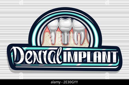 Logo vectoriel pour la clinique d'implant dentaire, panneau d'affichage décoratif foncé avec illustration de molaire en porcelaine avec vis, lettrage calligraphie unique pour le WO Illustration de Vecteur