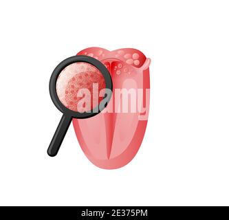 Inspection des récepteurs de goût sur l'illustration de la langue. Examen des tissus muqueuses sous la loupe pour la présence de candida. Illustration de Vecteur