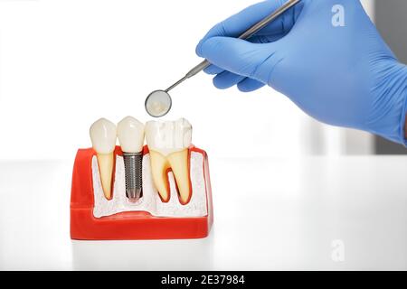 Vérification des dents et prothèses dentaires. Miroir buccal dans la main stomatologiste pendant le modèle d'examen de la mâchoire Banque D'Images