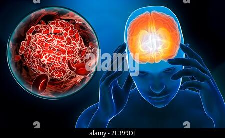Homme souffrant d'un accident cérébrovasculaire, d'un accident vasculaire cérébral ou d'une attaque cérébrale avec un caillot de sang ou un thrombus 3D. Médecine, patholo médical Banque D'Images