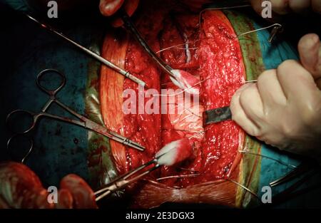 Chirurgiens suturant sur un patient malade après une opération effectuant une chirurgie sérieuse. Banque D'Images