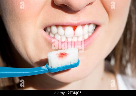 Femme avec des gencives saignantes pendant le brossage des dents. Maladie parodontale, scorbut Banque D'Images