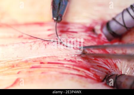 Aiguille et pince à épiler en cours de suture d'une plaie sur la peau. Banque D'Images