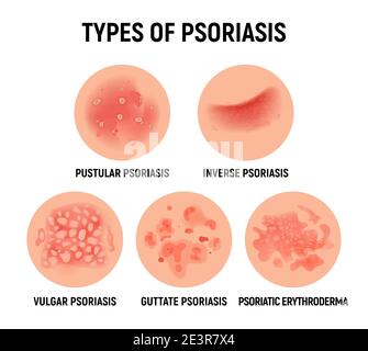 Psoriasis éruption cutanée vecteur peau infection des mains. Schéma de la dermatite de psoriasis eczéma Illustration de Vecteur