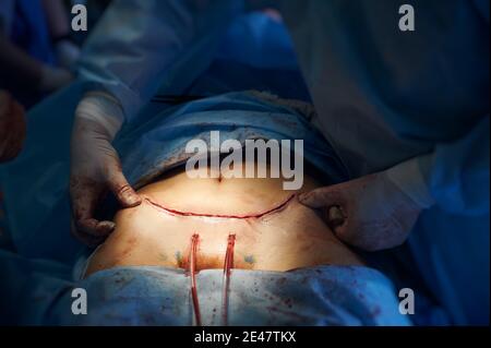 Gros plan des mains du chirurgien en plastique touchant le ventre du patient avec l'incision après la chirurgie du ventre. Un travailleur médical vérifie les sutures sur l'abdomen de la femme après une chirurgie plastique. Concept d'abdominoplastie. Banque D'Images