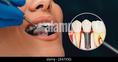 Dentisterie, publicité des prothèses dentaires. Implant dentaire près de la bouche ouverte du patient. Stomatologie moderne Banque D'Images