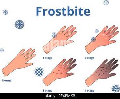 Phases de gelure, illustration vectorielle des mains Illustration de Vecteur