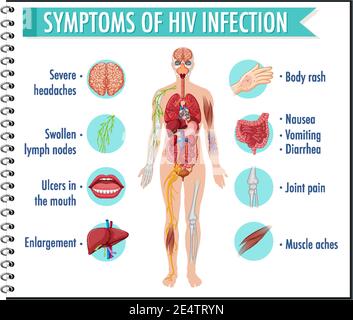 Illustration de l'infographie sur les symptômes de l'infection à VIH Illustration de Vecteur