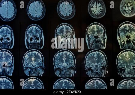 Lecture de l'image par résonance magnétique du cerveau. Film IRM d'un crâne humain et du cerveau. Neurologie l'arrière-plan. La médecine, la science, vue avant Banque D'Images