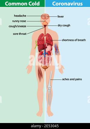 Illustration du rhume et du coronavirus sur fond transparent Illustration de Vecteur