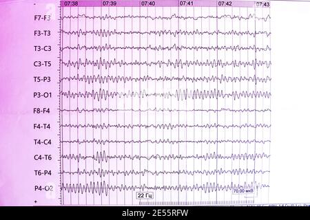 Les résultats de l'électroencéphalogramme sur papier, diagnostic de l'épilepsie Banque D'Images