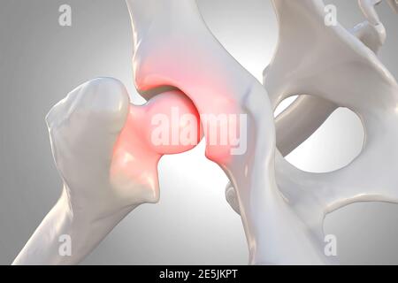 Dysplasie canine, os de chien avec articulation de la hanche visible et fémur affecté par l'inflammation due à la dysplasie, illustration 3d Banque D'Images