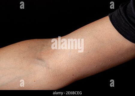 Image rapprochée de la section du coude d'une femme caucasienne (côté ventral) avec l'avant-bras étendu et le bras en rotation latérale. Le fond est noir céphalique et Banque D'Images