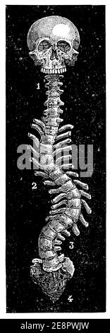 Rachis courbé scoliotique. Illustration du 19e siècle. Allemagne. Arrière-plan blanc. Banque D'Images