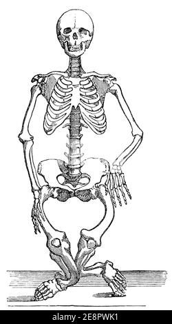 Squelette humain avec rickets. Illustration du 19e siècle. Allemagne. Arrière-plan blanc. Banque D'Images