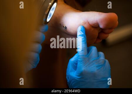 Enlèvement au laser des verrues sur le pied. Chirurgie dermatologique médicale dans la clinique. Banque D'Images