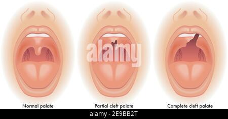 L'illustration médicale montre la différence entre un palais normal, un palais à fente partielle et un palais à fente complète, avec des annotations. Illustration de Vecteur