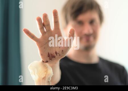 Abrasions sur la paume de la main droite d'un homme adulte. Soins à domicile. Retrait des bandages. Banque D'Images