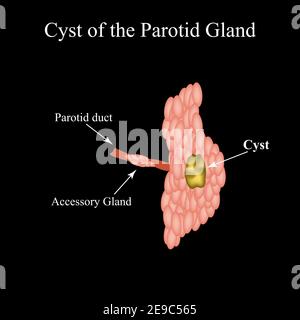 Kyste de la glande paratide salivaire. Structure de la glande salivaire parotide. Illustration vectorielle sur un arrière-plan isolé Illustration de Vecteur
