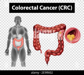 Schéma illustrant le cancer colorectal (CRC) sur fond transparent Illustration de Vecteur