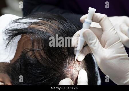 Processus de transplantation de cheveux, tirant les follicules de cheveux vers l'arrière et replanter. Banque D'Images