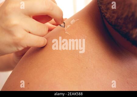 Peeling de la peau au dos et à l'épaule de l'effet de coup de soleil sur le corps du jeune homme du bain de soleil à l'été. Concept de coup de soleil dangereux Banque D'Images