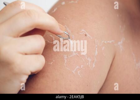 Peeling de la peau au dos et à l'épaule de l'effet de coup de soleil sur le corps du jeune homme du bain de soleil à l'été. Concept de coup de soleil dangereux Banque D'Images