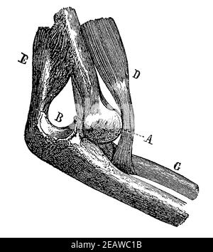Luxation du raccord coudé. Illustration du 19e siècle. Allemagne. Arrière-plan blanc. Banque D'Images