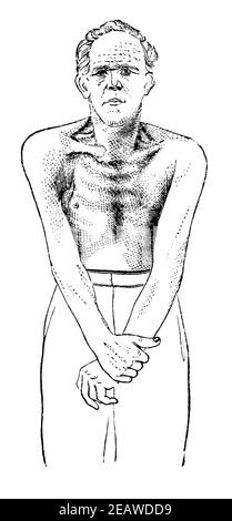 Paralysie musculaire du haut du corps d'un travailleur due à un empoisonnement chronique au plomb. Vue avant. Illustration du 19e siècle. Allemagne. Arrière-plan blanc. Banque D'Images