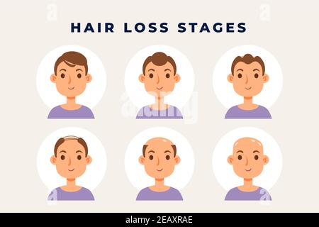 Schéma de perte de cheveux en dégradé illustration vectorielle. Illustration de Vecteur