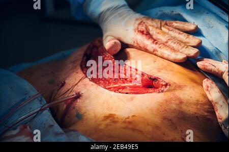 Gros plan de la plaie ouverte et des mains du chirurgien en plastique dans des gants stériles pendant la chirurgie tummy en clinique. Travailleur médical en chirurgie plastique abdominale. Concept de l'abdominoplastie et de la chirurgie esthétique. Banque D'Images