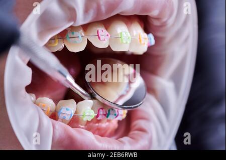 Gros plan de l'orthodontiste vérifiant les supports patient avec miroir dentaire. Personne avec un rétracteur de joue dans la bouche et des bretelles avec des bandes de caoutchouc multicolore sur les dents ayant une procédure dentaire en clinique. Banque D'Images