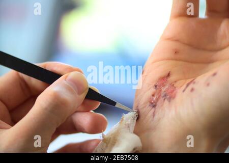 Abrasions sur la paume de la main droite d'un homme adulte. Soins à domicile. Retrait des bandages à l'aide d'une pince à épiler. Gros plan. Banque D'Images