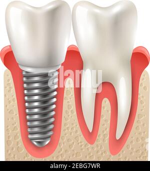 Implants dentaires et modèle de jeu de dents gros plan vue latérale réaliste illustration du vecteur d'image Illustration de Vecteur