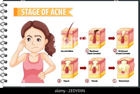 Étapes de l'anatomie de l'acné de peau avec une femme faisant stressant pose de l'illustration Illustration de Vecteur