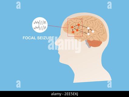 Illustration d'une activité électrique anormale dans une région du cerveau humain provoquant une crise focale ou une épilepsie. Cerveau humain et fond bleu. Illustration de Vecteur