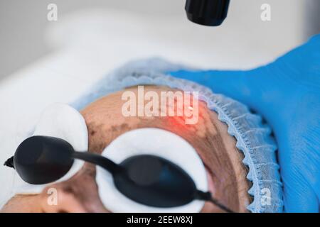Remplissage laser en fibre de carbone de la peau du visage gros plan. Rajeunissement de la peau au laser. Banque D'Images
