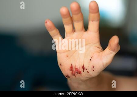 Plaies à l'intérieur de la paume de la main droite d'un homme adulte après avoir enlevé les bandages. Gros plan. Banque D'Images