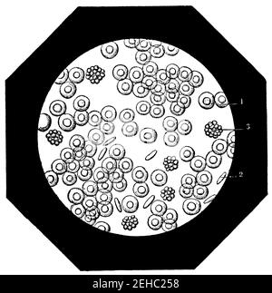 Les cellules sanguines humaines, vues au microscope, ont été agrandies 600 fois en moyenne. Illustration du 19e siècle. Allemagne. Arrière-plan blanc. Banque D'Images