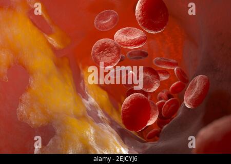 Plaque de cholestérol dans l'artère, vaisseau sanguin avec cellules sanguines coulant. Illustration 3D Banque D'Images
