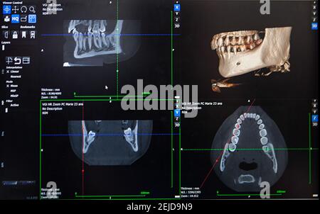Reconstruction 3D à partir d'une image scanner de la mâchoire d'un patient pour une impression 3D personnalisée.