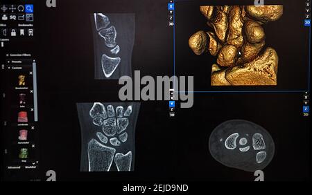Reconstruction 3D à partir d'une image scanner du poignet d'un patient pour une impression 3D personnalisée.