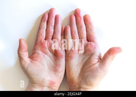 Irritation de la peau de l'eczéma sur les mains d'une femme de 52 ans ...