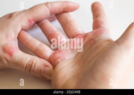 Eczéma allergique fort sur les mains. Peau rouge fissurée avec des cloques Banque D'Images