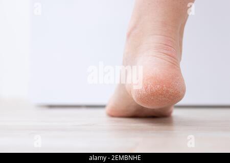 La peau sèche du talon est fissurée. Concept de traitement avec crèmes hydratantes et exfoliation pour la guérison des blessures et de la douleur lors de la marche. Déshydraté s Banque D'Images