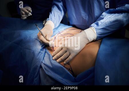 Fermez les mains du chirurgien dans des gants stériles blancs à l'aide de scalpel, en effectuant une chirurgie plastique en salle d'opération. Chirurgien coupant le ventre du patient avec des marques bleues sur la peau. Concept de médecine et d'abdominoplastie. Banque D'Images