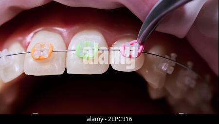 Macro instantané de la procédure dentaire, processus de fixation des bandes de caoutchouc colorées aux supports en céramique blanche. Image en gros plan des dents supérieures et des pinces portant une bande en latex rose Banque D'Images